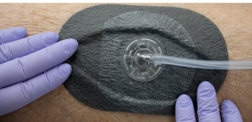 Innovaties in negatieve druktherapie